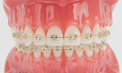 lingual braces