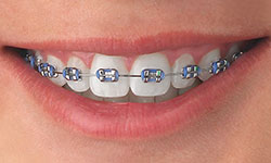 metal braces